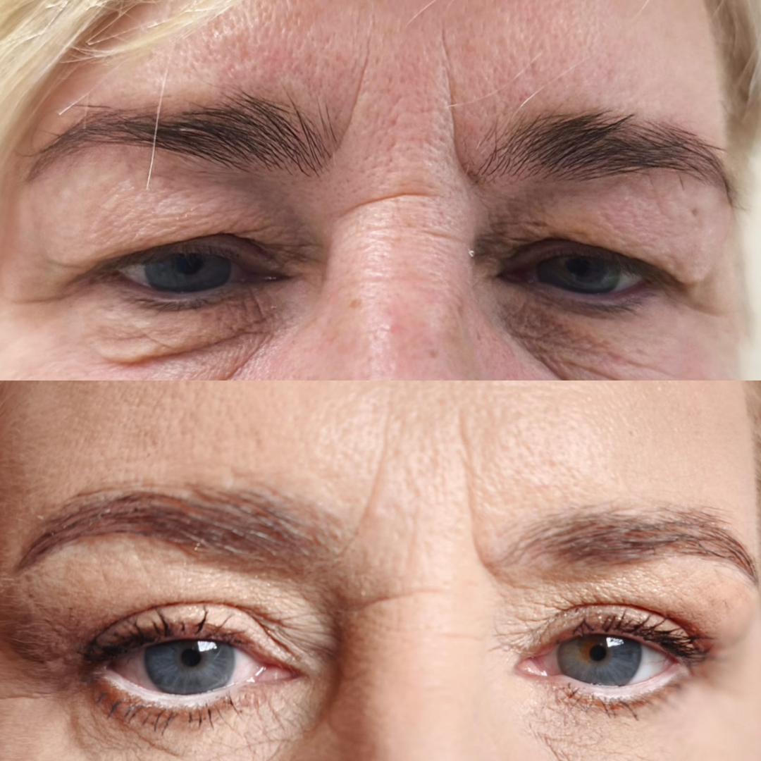 Blefaroplastyka przed i po Gdynia Centrum Dykstas